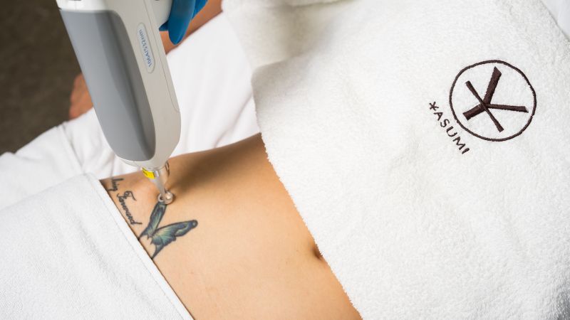 usuwanie tatuażu, jak usunąć tatuaż, laser na tatuaż Yasumi